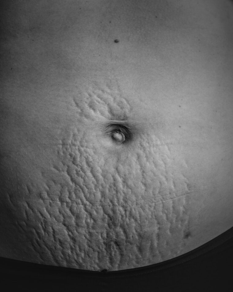 Vientre con estrías después del parto, en blanco y negro